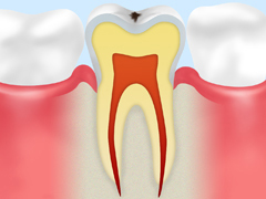 C0：初期の虫歯