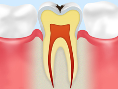 C1：エナメル質の虫歯