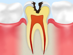 C2：象牙質の虫歯