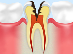 C3：神経にまで達した虫歯