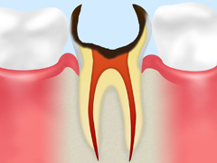 C4：歯根にまで達した虫歯